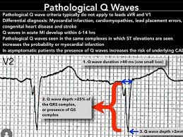 Image result for Q Wave