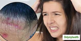 Pimples on head hair loss acne or pimples does not cause hair loss, even when it develops along the scalp, active lesions are not likely to damage the hair follicles enough to lead to localized baldness. Do You Have Acne On Scalp Know The 5 Main Causes Of Scalp Acne Breakouts