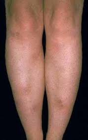 Image result for erythema nodosum