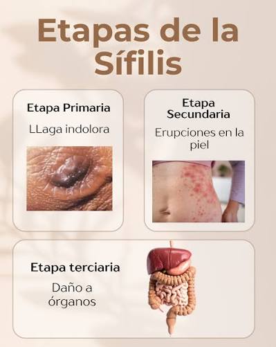 🦠 SÍFILIS: Infórmate, previene y testea Es una infección de transmisión  sexual que muchas veces no presenta síntomas visibles. ✓ Usa preservativo ✓  Realízate el test de ITS ✓ La sífilis tiene
