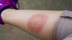 Erythema migrans, em) to wczesny, wstępny jest to faza, w której uwidaczniają się poważne powikłania kardiologiczne, neurologiczne lub przewlekłe. Borelioza Wystepowanie Fazy Diagnostyka Leczenie Neuroborelioza Zdrowie