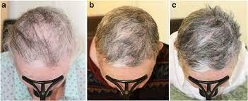 So what can we glean from this story? Successful Treatment Of Acute Diffuse And Total Alopecia Of The Female Download Scientific Diagram