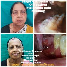 Cancer that arises from the jaw bone is termed primary jaw cancer. Orchid Oncology Center