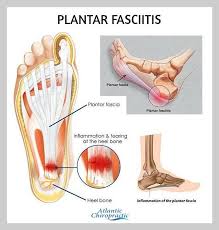 Pin On Plantar Fasciitis Remedy