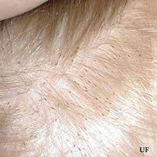 The difference is that lice eggs from 30 years ago without the super lice mutation could be affected by pesticides, that might prevent them from hatching. Body Louse And Head Louse Pediculus Spp