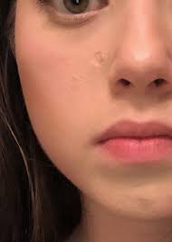 These can include the clinic you choose and the type of therapy your dermatologist getting rid of your acne related spots doesn't necessarily mean you end up with perfect skin. Best Way To Remove A Circular Pitted Chicken Pox Scar Photo