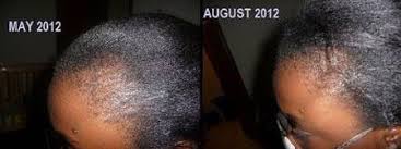 And jamaican black castor oil is just a better version of this. Jamaican Black Castor Oil Before And After Pictures 2 Castor Oil For Hair Growth Jamaican Black Castor Oil Castor Oil For Hair