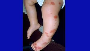 Senile purpura is benign, easy bruising that affects older adults. Henoch Schonlein Purpura Healthychildren Org