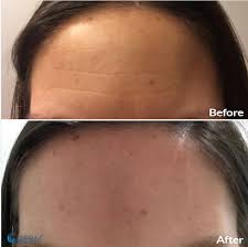 Most people see the results of their treatment within three to five days. Dysport The Derm Dermatologists In Cook County Il