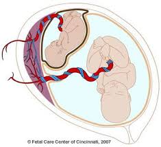 Twin Twin Transfusion Syndrome Ttts Cincinnati Fetal Center Cincinnati Children 39 S Hospital Medical Center Fetal Twins Cincinnati Childrens Hospital