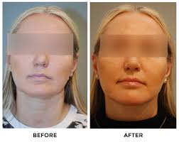 Face/Neck lift Before & After Pictures