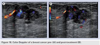Color Doppler Sonography Characterizing Breast Lesions