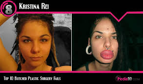 Sep 23, 2021 4:39 pm · by anna quintana. Top 10 Botched Plastic Surgery Fails Before And After Album On Imgur