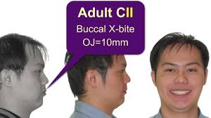 CC344. Ext. vs Non-ext. Case Report: Buccal X-Bite