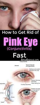 How To Get Rid Of Pink Eye Conjunctivitis Fast You Typically Can T Get Rid Of Viral Pink Eye But You Can Reli Pink Eyes Bacterial Pink Eye Treating Pink Eye