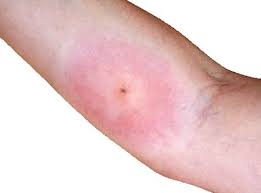 Pin On Skin Conditions
