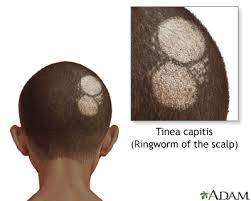 Mix a cleaning solution of 1 part bleach and 10 parts water. Tinea Capitis Information Mount Sinai New York