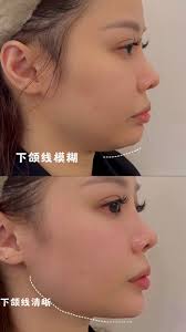 精致侧轮廓，从下颚线开始。, 下颚线的清晰与否，直接影响面部比例与视觉年龄。通过科学评估与精细设计，让轮廓自然立体，重拾年轻与自信。, #马来西亚  #骨像幼态抗衰 #幼态审美 #美学设计 #徐薈清 #解锁更多变美的理念让你变美省心又省力 #审美 #高定抗衰幼态脸 #徐薈清灵动眼