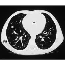 95% of nodules found are benign. Largest Ever Uk Lung Cancer Screening Study Aims To Improve Early Detection Uclpartners