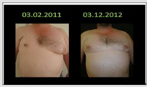 382 dcis of breast with poland syndrome—tcm wong et al. Correction Of Poland Syndrome Chest Hypoplasia Using Polymethylmethacrylate Implant Biomedres