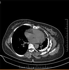 Pleural effusion is an accumulation of fluid in the pleural cavity between the lining of the lungs and the thoracic cavity (i.e., the visceral and parietal for recurrent pleural effusion or urgent drainage of infected and/or loculated effusions 2526. Chronic Tuberculous Empyema Radiology Case Radiopaedia Org
