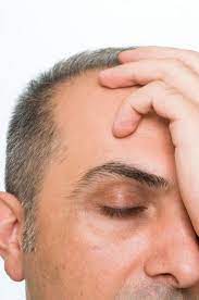 If you go unchecked but have maintained most of your hair by middle age, then your sensitivity to dht is probably on the low side, meaning you have a slower rate of male pattern hair loss going also, you may have noticed that men, when they bald, never lose the hair around the sides and back of the head. 5 Early Signs You Re Going Bald Fight Hair Loss Immediately