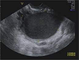 Most ovarian cysts are small and don't cause symptoms. Ovarian Cyst Observed On Transvaginal Ultrasound In A 25 Year Old Download Scientific Diagram