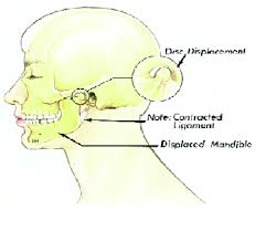Temporomandibular jaw joint surgery temporomandibular jaw joint surgery. Tmj Derangement And Sunct Syndrome Co Morbidity