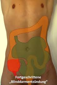 Eine blinddarmentzündung zu erkennen, ist nicht leicht. Blinddarm Op In Nurnberg Klinik Hallerwiese De