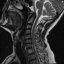 Cureus Atypical Presentation Of Parsonage Turner Syndrome