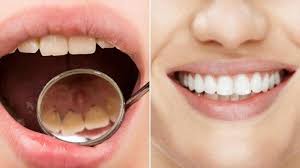 Bisakah membersihkan karang gigi dengan cara alami? Cara Alami Ampuh Hilangkan Kerak Gigi Di Rumah Ada Soda Kue Hingga Kulit Jeruk Serambi Indonesia