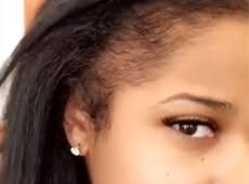 Hair loss can occur anywhere on the body, but most commonly affects the scalp. Reality Tv Stars Talk Post Partum Thinning Edges And Hair Loss