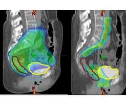 Image result for Intensity-Modulated Radiation Therapy