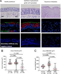 A surface layer of mucinous columnar cells can often be in the cervix, the area of the epithelium that has undergone metaplastic change is called the transformation zone (tz). P63 Krt5 Basal Cells Are Increased In The Squamous Metaplastic Epithelium Of Patients With Radiation Induced Chronic Rhinosinusitis Radiation Oncology Full Text