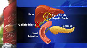 One of the treatments for those affected of this condition is a new diet regimen. Moves In Medicine What Is Gallbladder Attack Gallstones Surgery Treatment