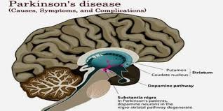 Oct 24, 2019 · webmd explains the possible causes of parkinson's disease. Parkinson S Disease Causes Symptoms And Complications Assignment Point
