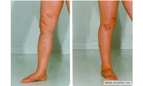 Millionbehandlingen som kan hjelpe, må hun betale selv. Utskriftsvennlig Versjon For Artikkel