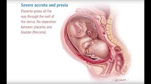 Placenta Accreta Myths And Facts Brigham Health Hub