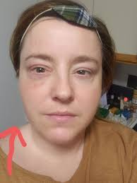 Is it normal that I still have swelling nine days after the surgery? I feel  particularly bad, especially when I wake up, as my eyes always appear  extremely swollen🥲