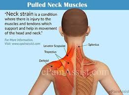 Pulled Neck Muscle Or Neck Strain Pulled Neck Muscle Neck And Shoulder Muscles Muscles Of The Neck