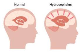 Image result for Hydrocephalus