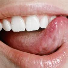How To Get Rid Of Tongue Sores Ehow Canker Sore Tongue Sores Blister On Tongue