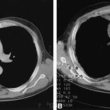 See full list on mesothelioma.net Pdf A Phase Ii Study Of Gemcitabine In Patients With Malignant Pleural Mesothelioma