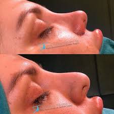 Thick Skin Bulbous Tip Rhinoplasty Assoc Prof Dr Suleyman Tas Rhinoplasty Rhinoplasty Nose Jobs Thick Skin
