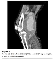 Deep Vein Thrombosis Pulmonary Embolus Aneurysm is a delated vessel, more precisely, a part of the blood vessel, where the wall is weaker, delates, or bulges.