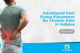 Image result for Intrathecal Pump