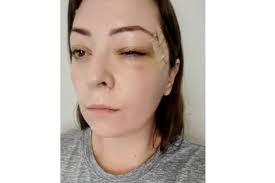 Fundraiser by Heather Hernandez : Invasive Melanoma Removal and Facial  Reconstructive Surgery