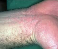 Index Of Site Images Clinical Pic G Gloves And Socks Syndrome