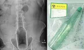 Man has a glass bottle stuck in his rectum after 'using it to scratch his  itchy backside' | Daily Mail Online