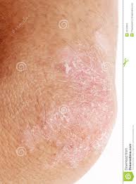 Foto sobre psoríase no cotovelo do ` s da senhora no fundo escuro fim acima. Psoriase No Cotovelo Imagem De Stock Imagem De Itching 40723091